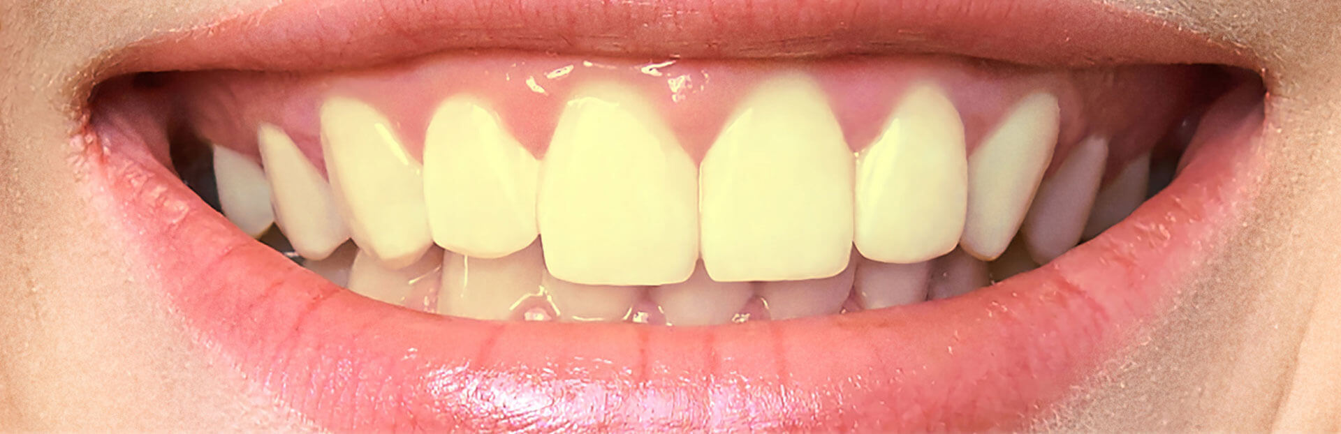 Teeth Whitening in Sri Lanka